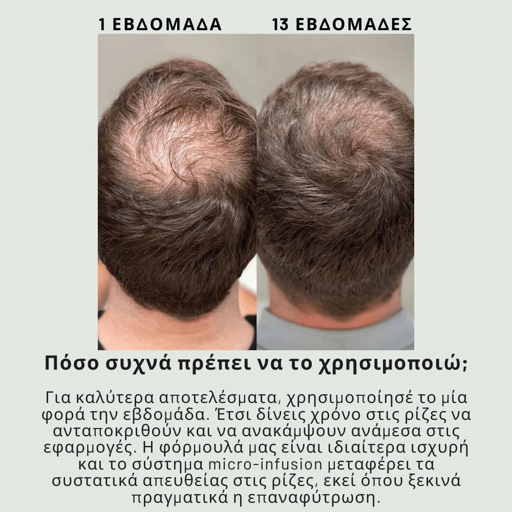 Ενίσχυσης & Επαναφύτρωσης [Hair Reactivation]