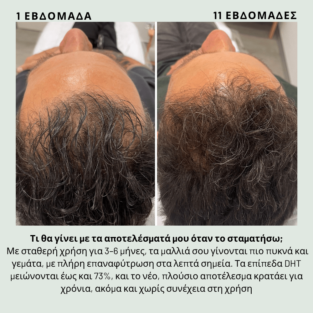 Ενίσχυσης & Επαναφύτρωσης [Hair Reactivation]