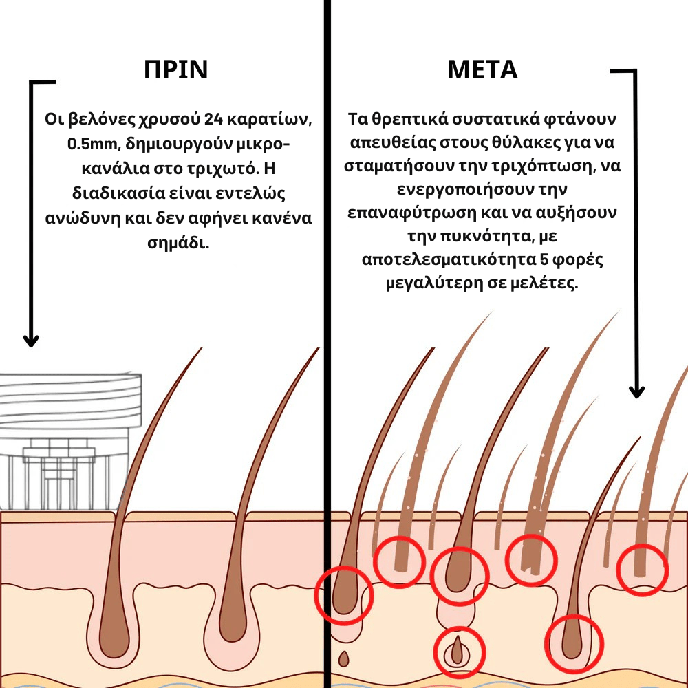 Ενίσχυσης & Επαναφύτρωσης [Hair Reactivation]