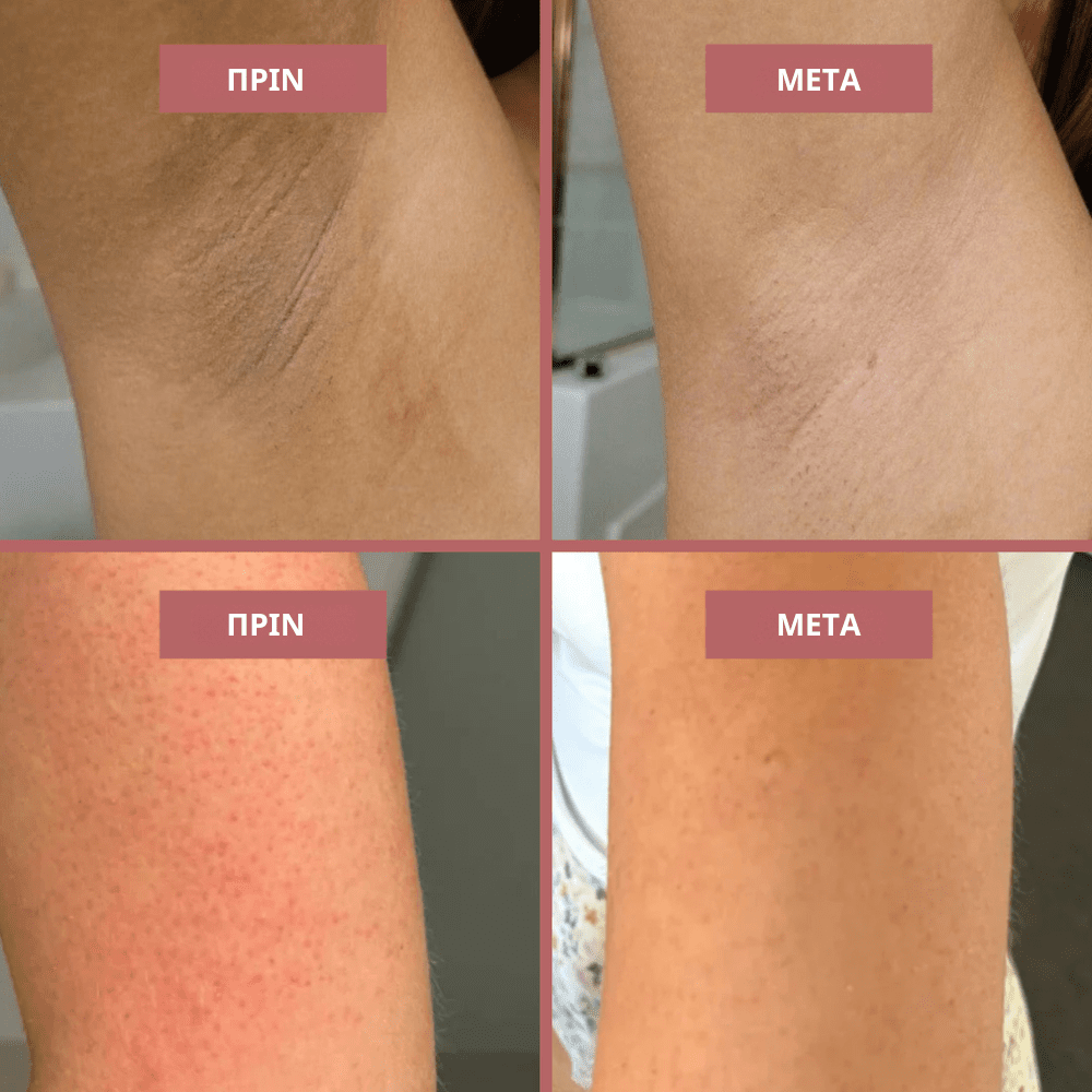 Απολεπιστικό Spray με Kojic Acid [Exfoliating Spray]