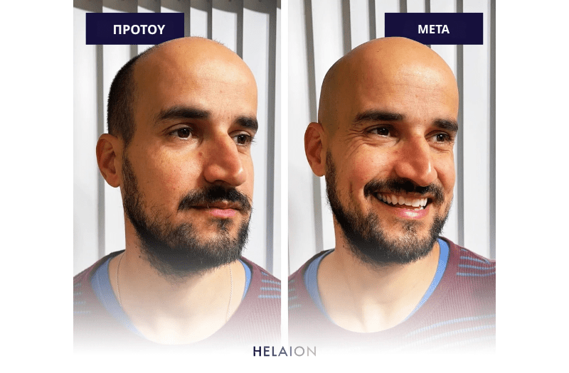 Ανδρικό Ηλεκτρικό Ξυριστικό [Men Shaver]